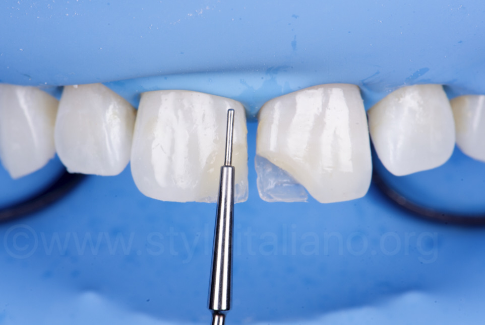 Trám răng thẩm mỹ: Quy trình, lợi ích và những điều cần biết