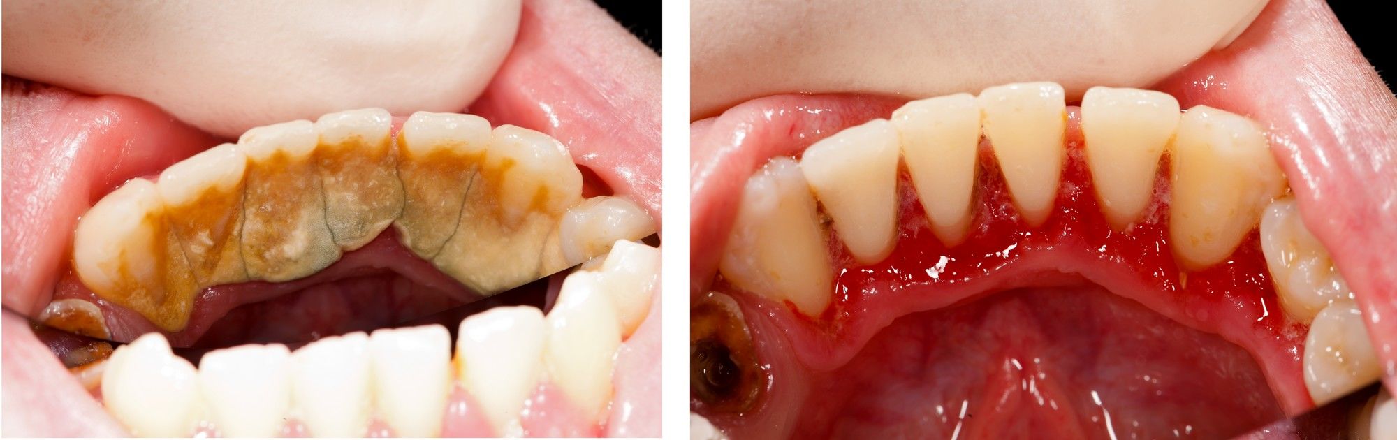 Bảng giá cạo vôi răng tại TP.HCM? Các yếu tố ảnh hưởng giá cả