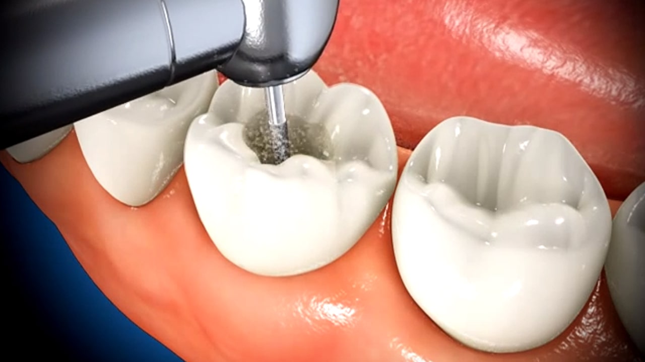 Trám răng sâu có đau không? Mất bao lâu thì ăn uống lại được