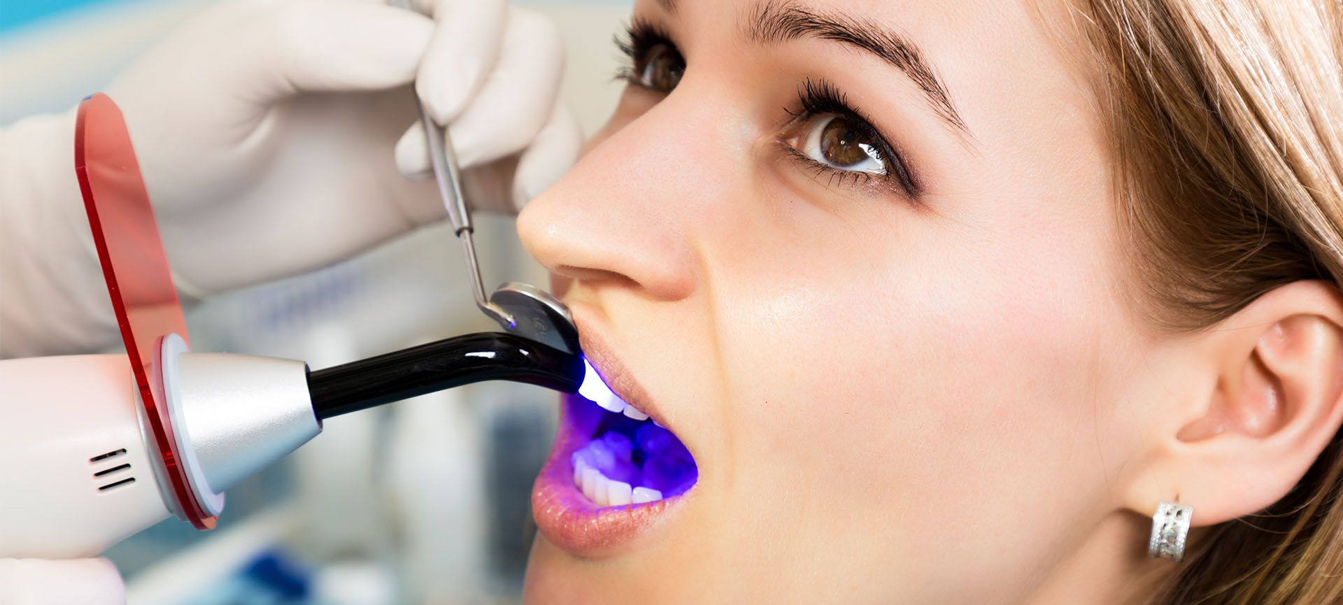 Trám răng là gì? Quy trình trám, chi phí và thời gian thực hiện