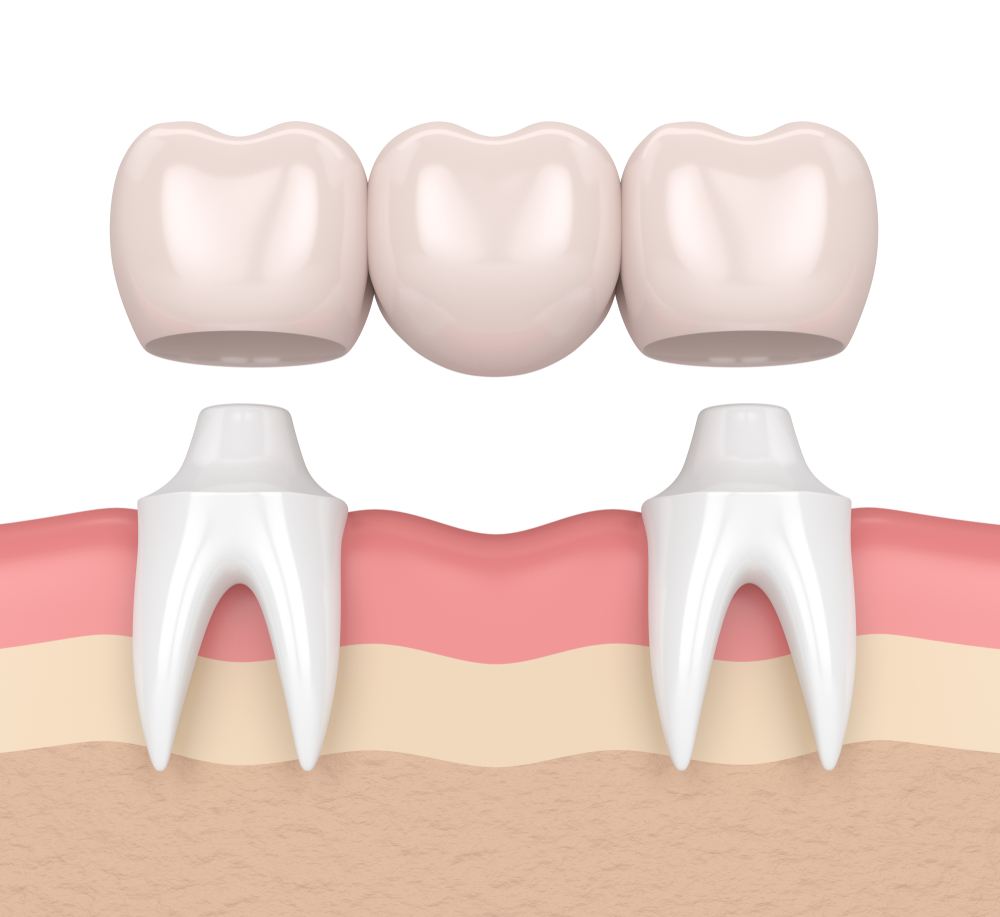 Cầu răng sứ cần mài nhỏ hai răng lân cận để làm trụ cầu