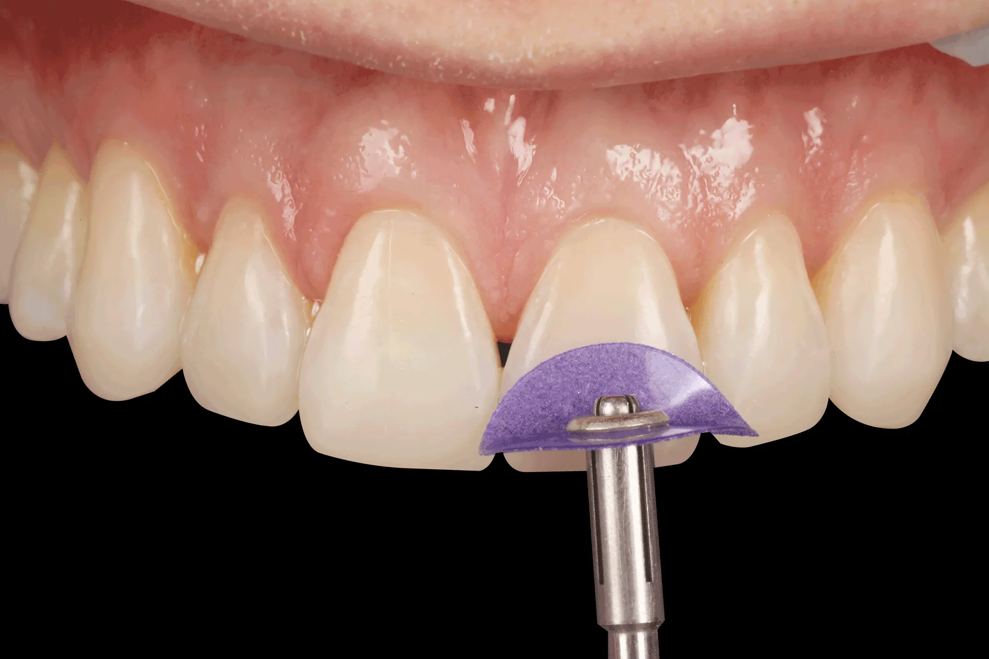 Các vật liệu trám răng phổ biến hiện nay? Nên sử dụng loại nào?