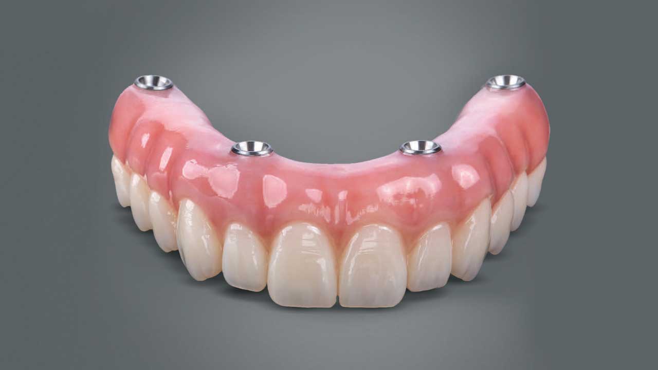 Chi phí trồng răng giả là bao nhiêu? Bảng giá mới nhất tại TPHCM