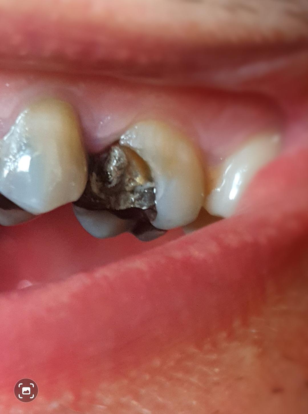 Miếng trám bị hở, bong sút cần được trám lại