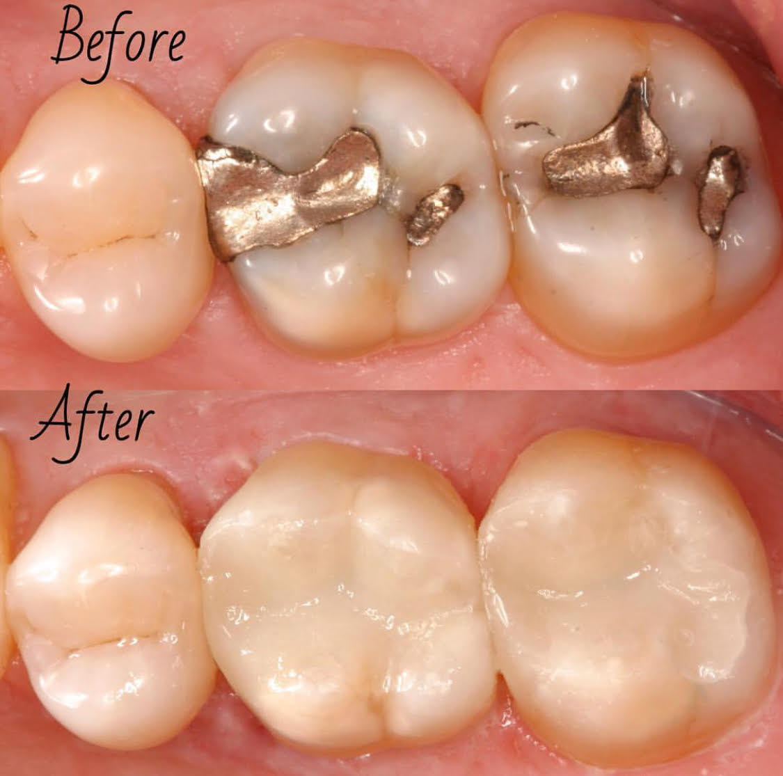 Những miếng trám bị bung, cần được trám lại sớm để tránh hậu quả nặng nề hơn