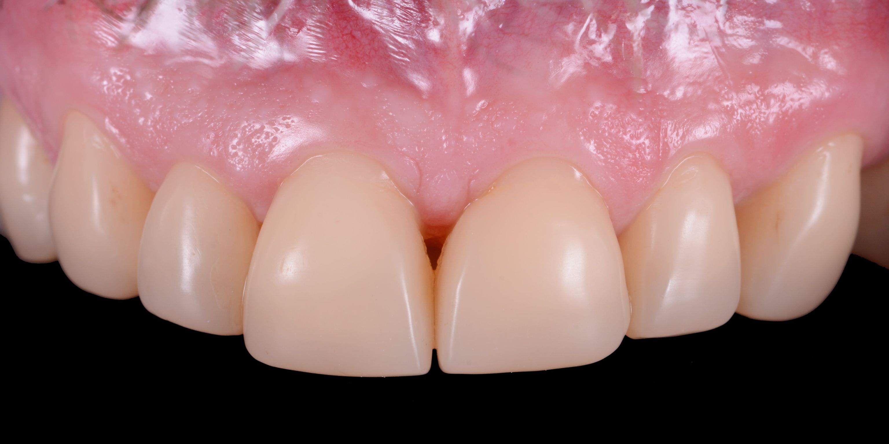 Trám răng có giữ được lâu không? Và bao lâu thì phải trám lại?