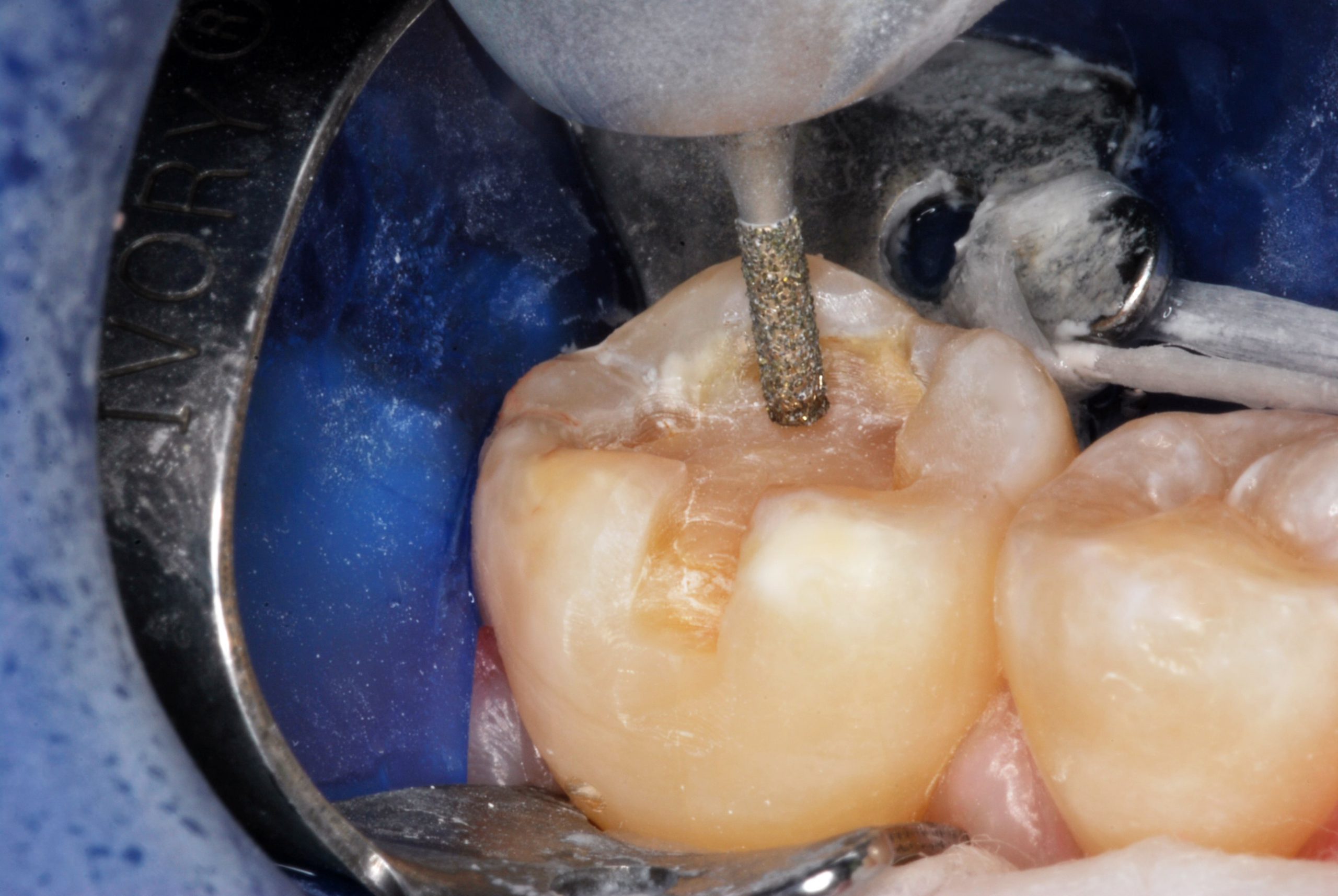 Lựa chọn vật liệu trám cần được quyết định bởi bác sĩ