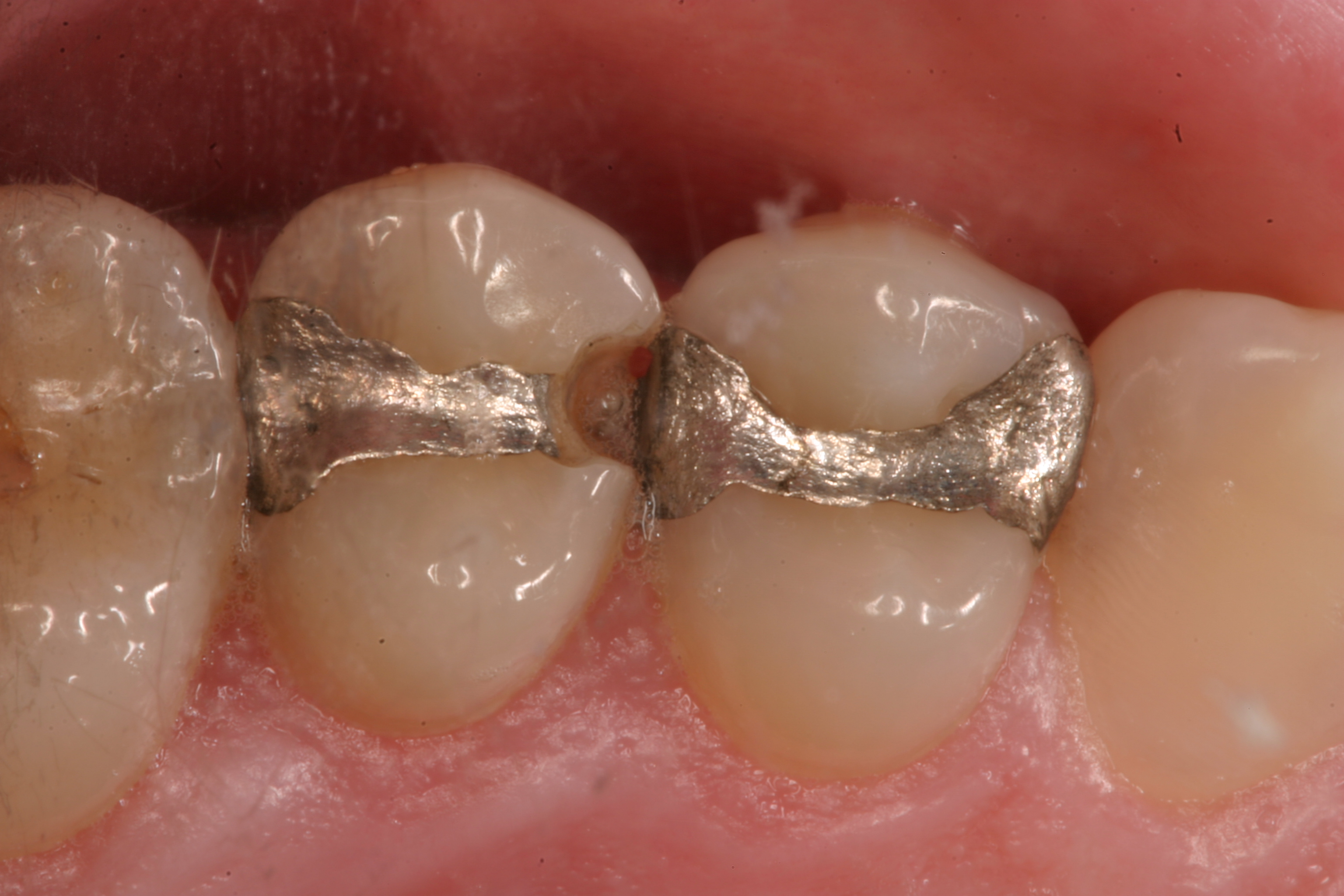 Trám răng bị bung, bị vỡ xử lý như thế nào? Giải đáp từ chuyên gia
