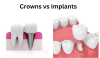 So sánh trồng răng Implant và cầu răng sứ: Nên chọn phương pháp nào?